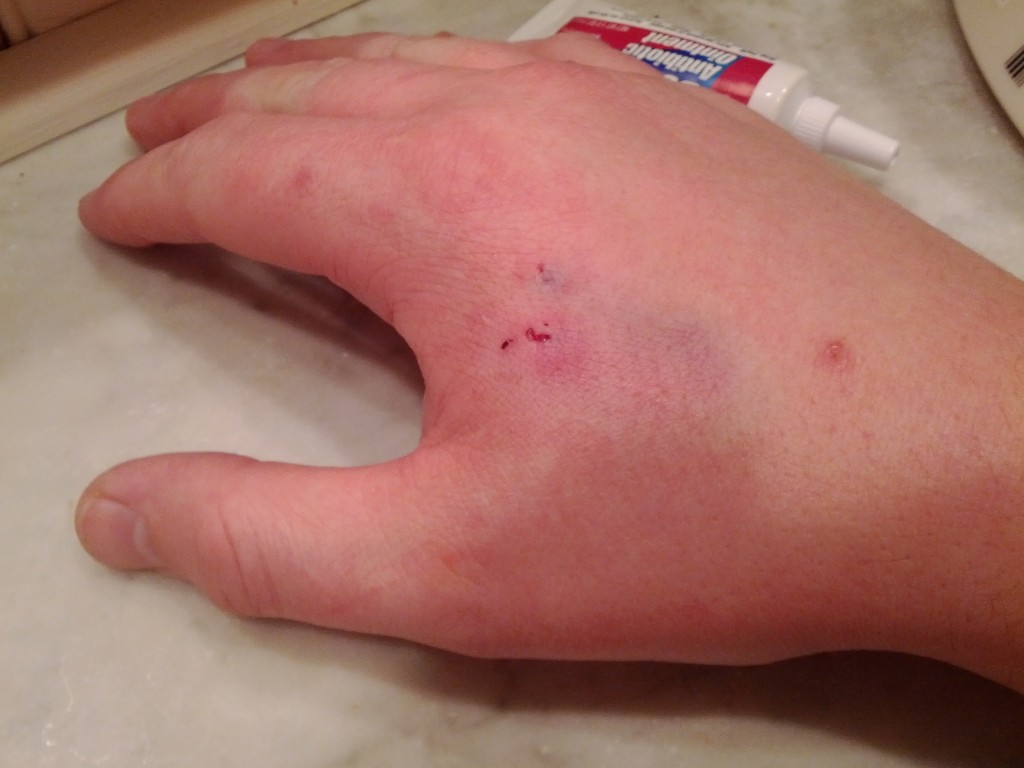 RFID implant removal and replacement Amal Graafstra Technologist, Author & Double RFID Implantee